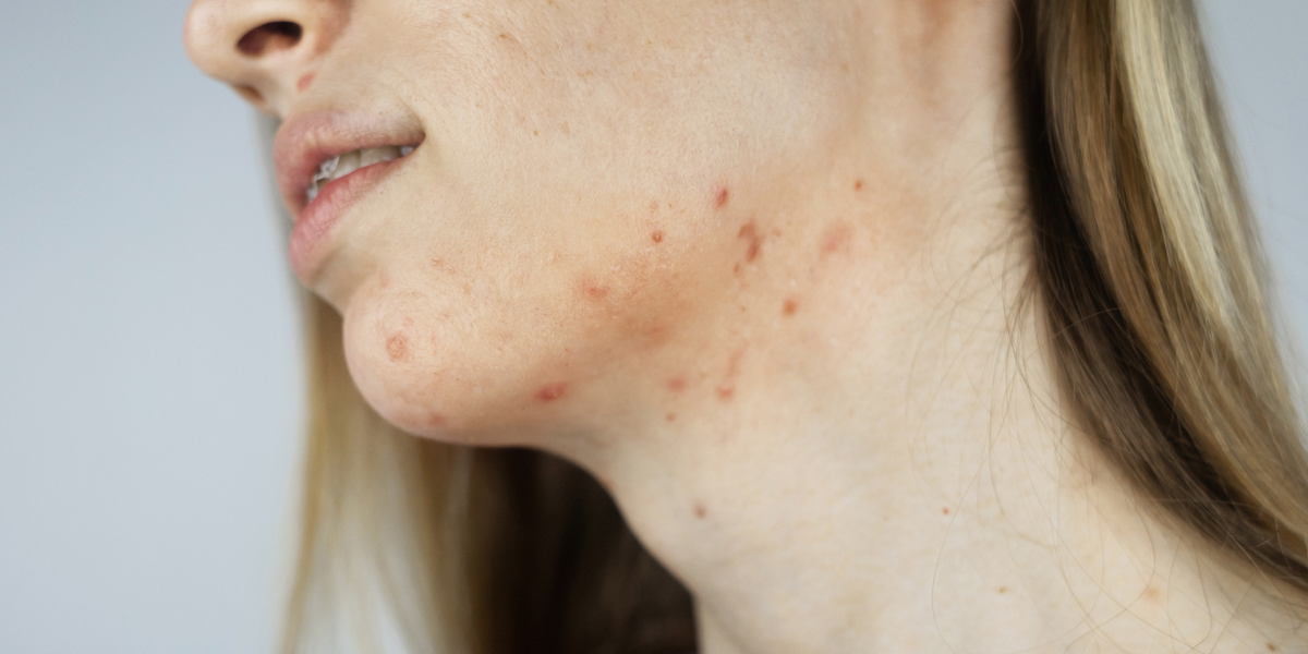 Naturopathie acné hormonale