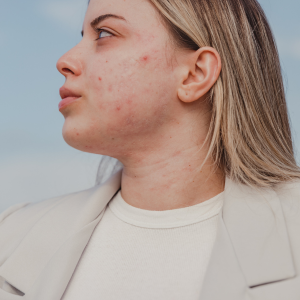 acné hormonal naturopathie