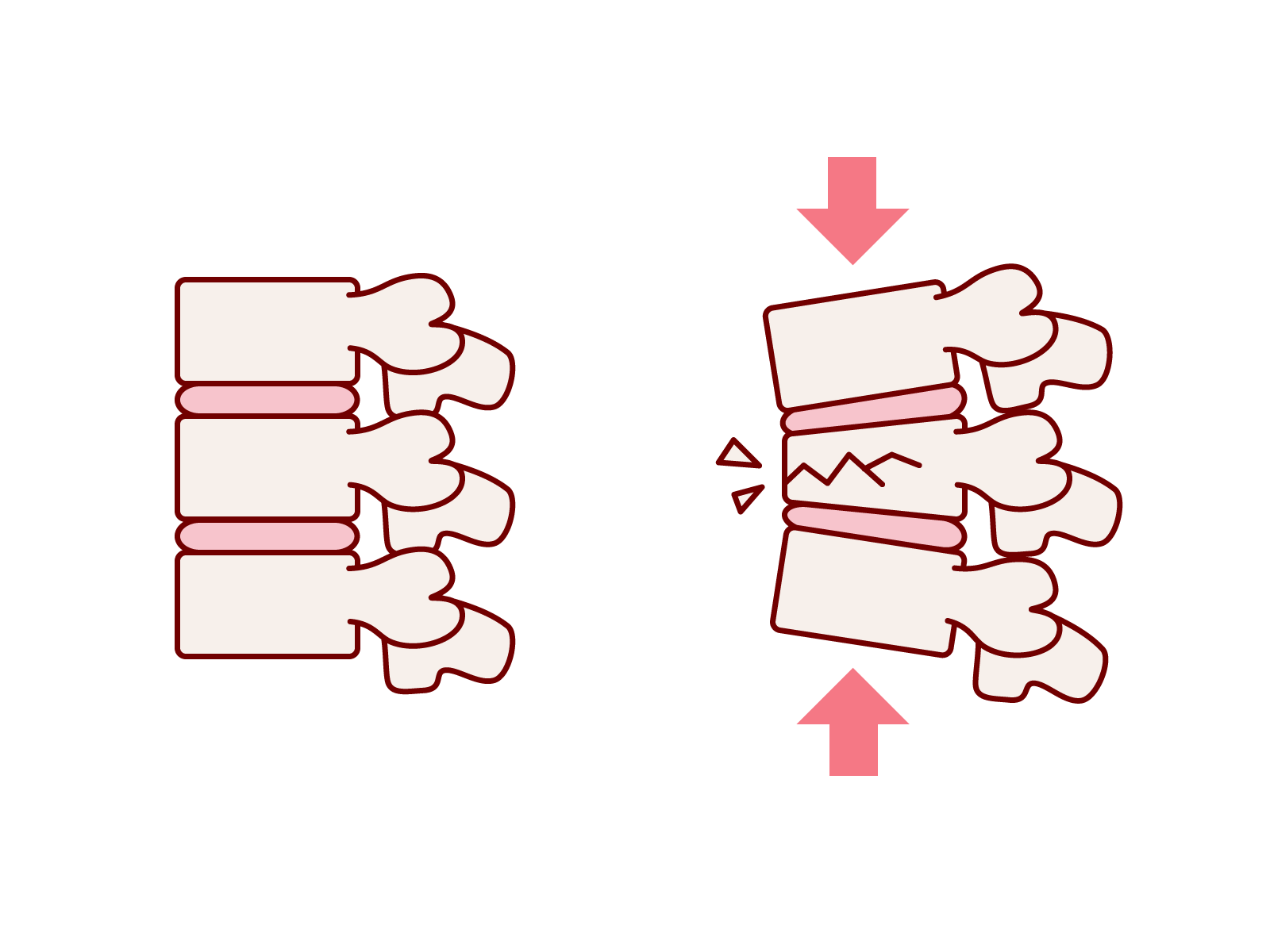 整体で進める圧迫骨折後の正しいケア法