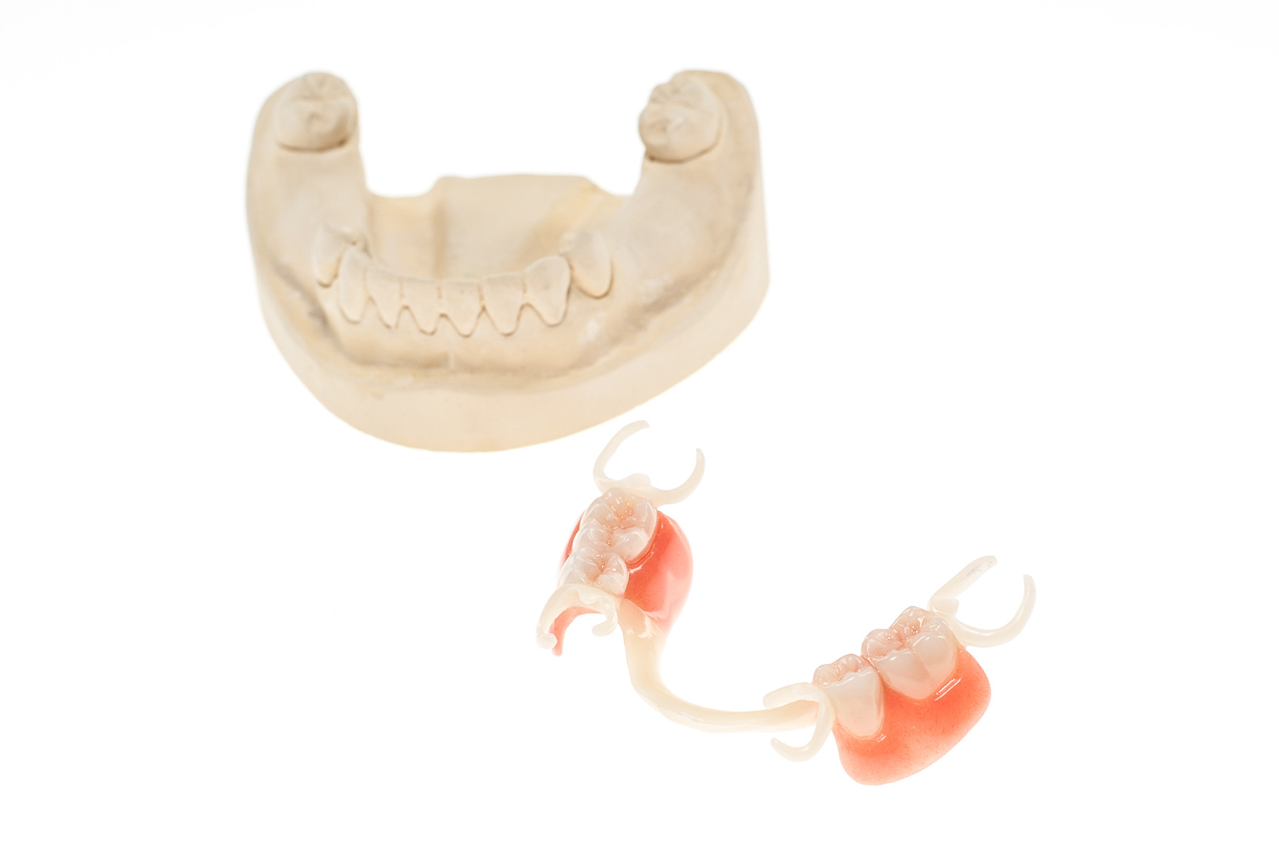 Zahnfarbene Modellgussprothese aus Polyoxymethylen