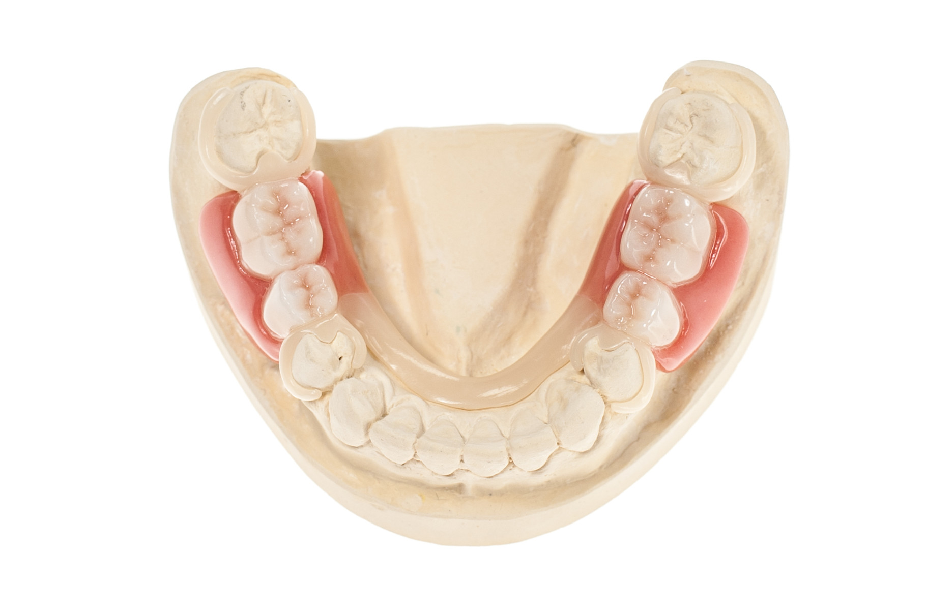 Zahnfarbene Modellgussprothese aus Polyoxymethylen