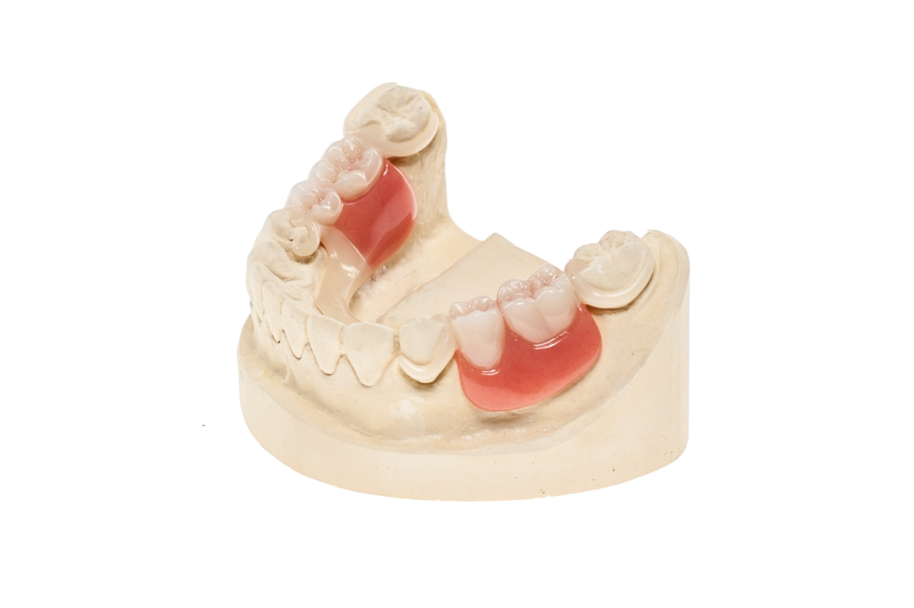 Zahnfarbene Modellgussprothese aus Polyoxymethylen