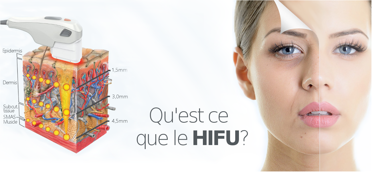 Аппарат HIFU 8d. HIFU smas лифтинг аппарат. 4d HIFU насадки. Аппарат ультраформер смас. Что лучше смас или рф