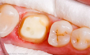 Dentinadhäsiver Srumpfaufbau