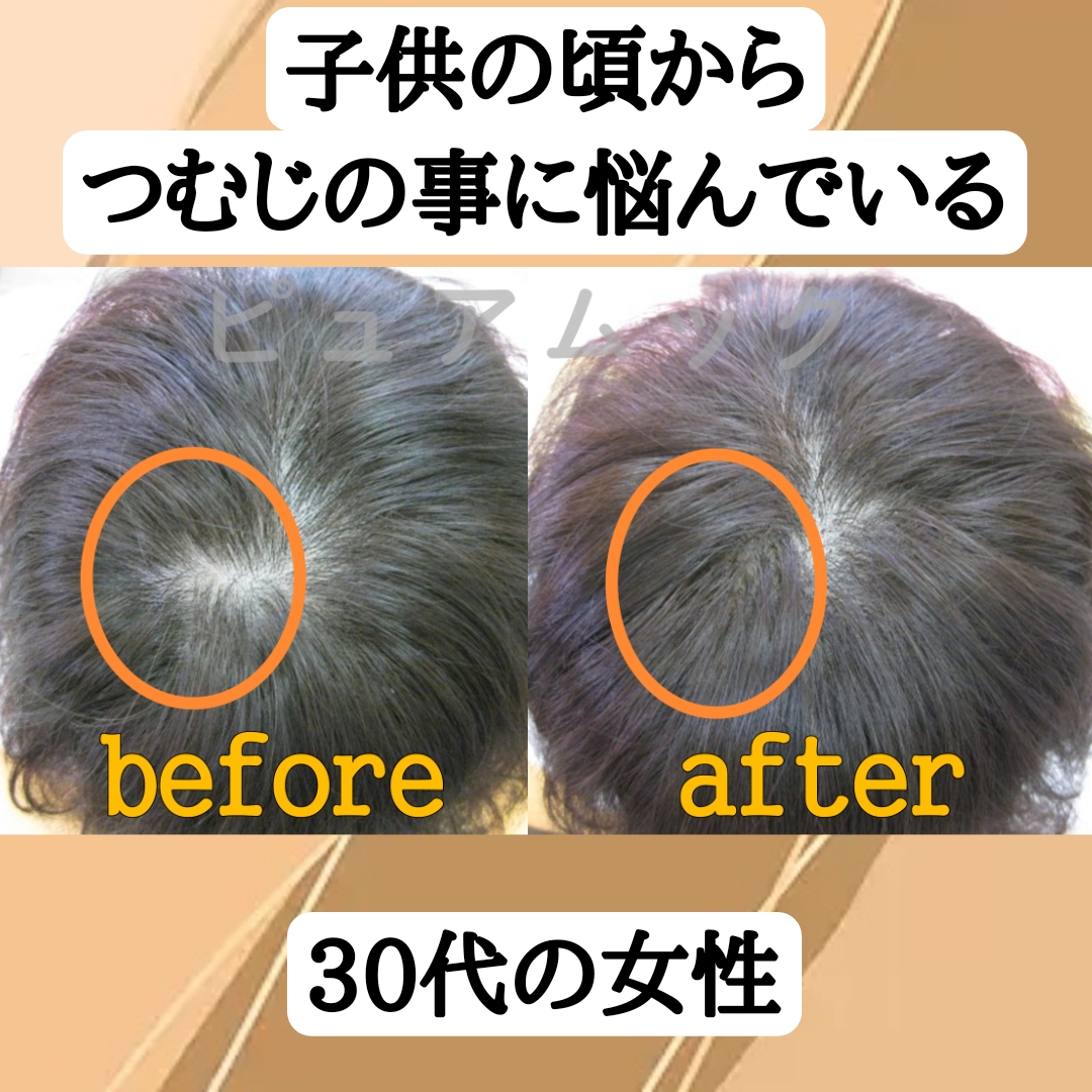 たった1時間で長年のコンプレックスつむじ割れ解消！