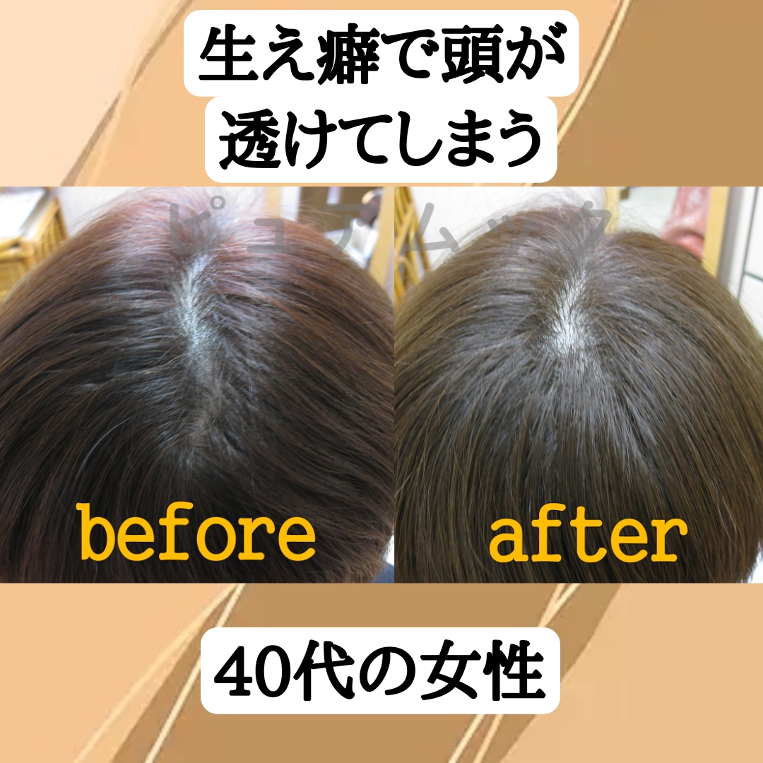 生え癖で頭が透けてしまう！増毛エクステで解決ました。
