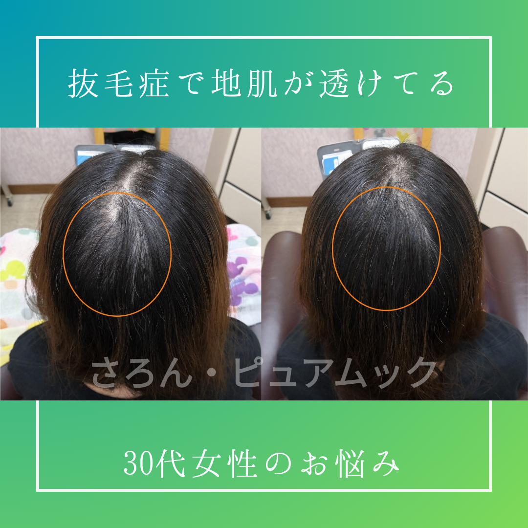 抜毛症で地肌を隠したい女性の施術例！短い髪でも結べるの？