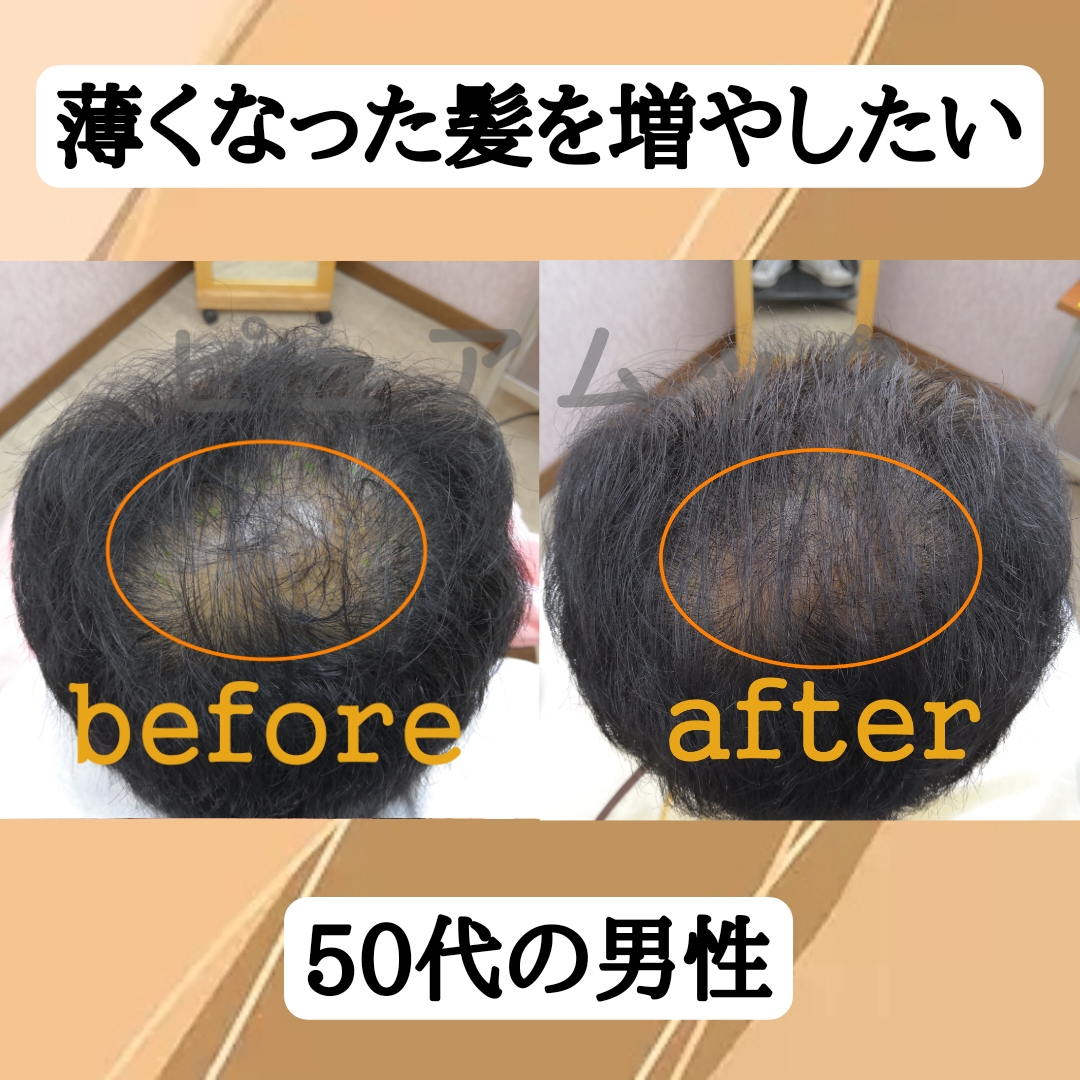 薄くなった髪を増やしたい50代の男性