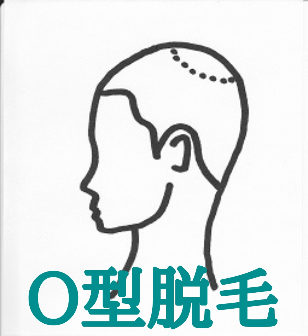 女性にも男性型脱毛症ってあるんですよ。