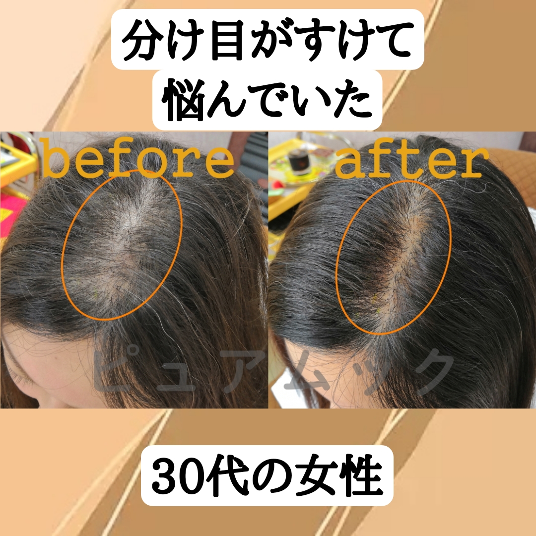 分け目が透る30代の女性をエクステ増毛で解決