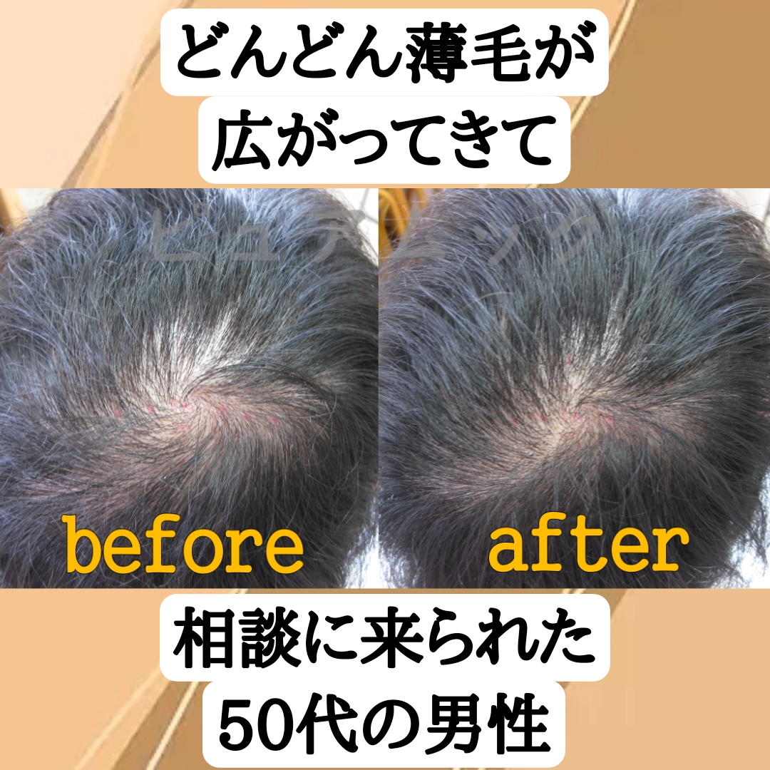 AGA経験の理容師が悩み解決！どんどん薄毛が広がってきた50代男性