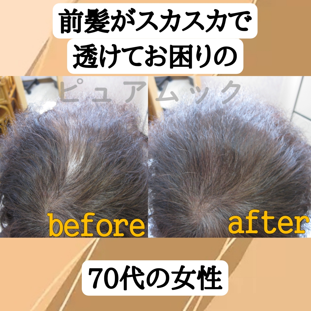前髪が透けてお困りの70代の女性。エクステ増毛で若返り！