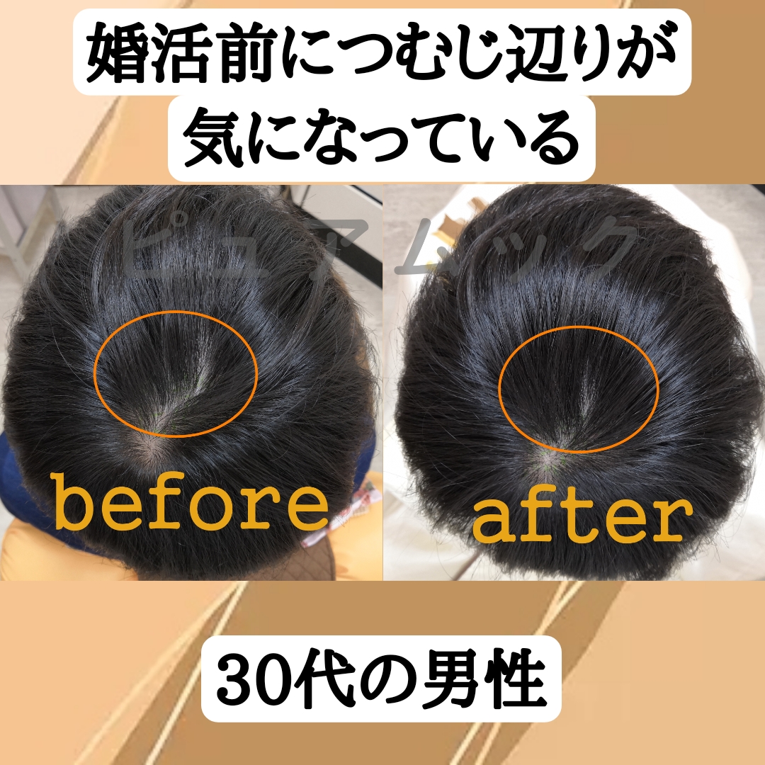 婚活前につむじ辺りを増毛エクステでカバーして自信をつける。