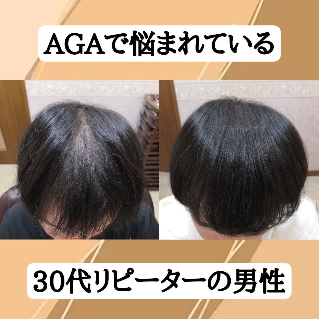 AGAで悩まれている30代リピーターの男性