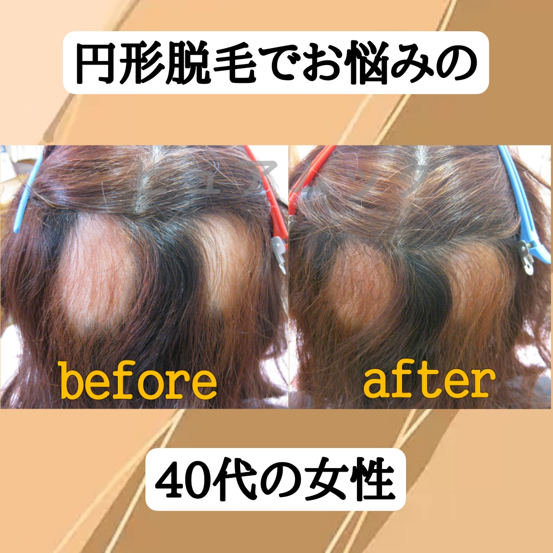 40代女性、円形脱毛症をエクステ増毛で悩み解消
