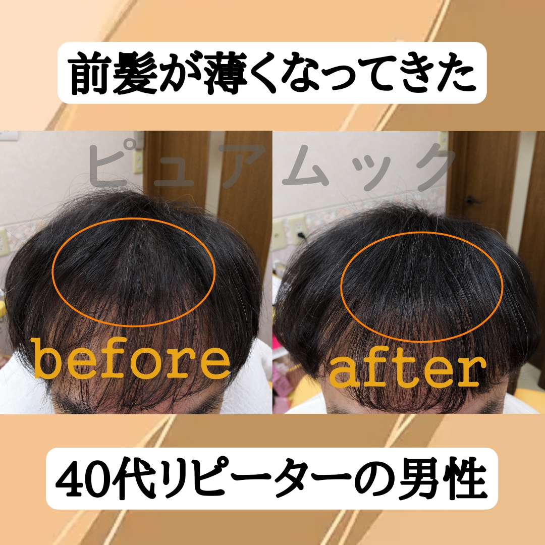 前髪が薄くなってきた40代リピーターの男性