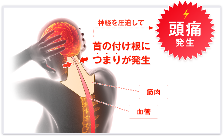 首の付け根につまりが発生　神経を圧迫して頭痛発生
