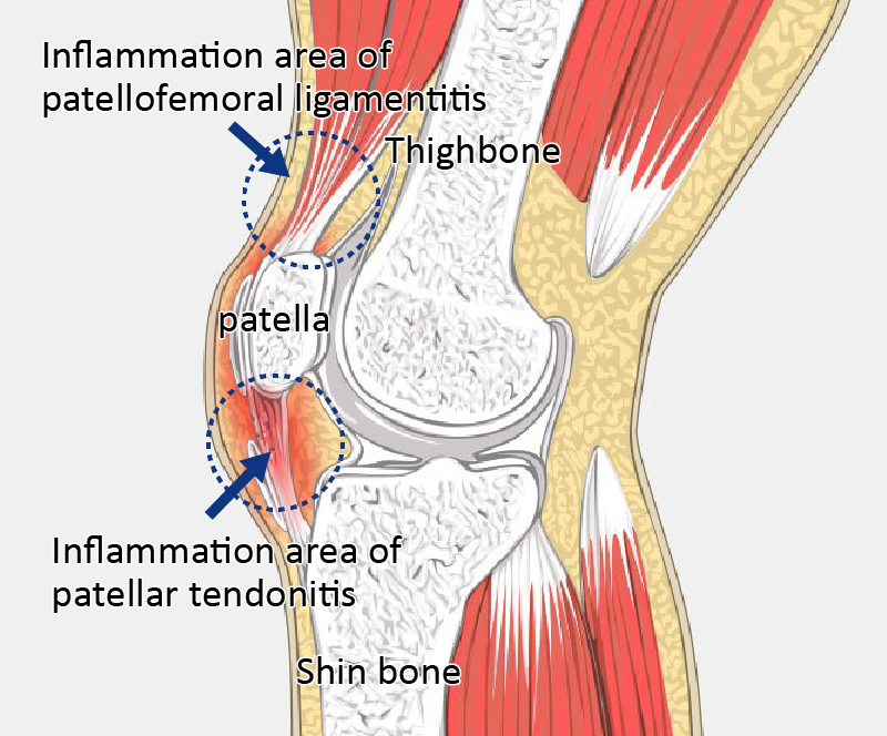 Jumper's Knee FAQ Okuno Clinic Pain relief treatment Japan