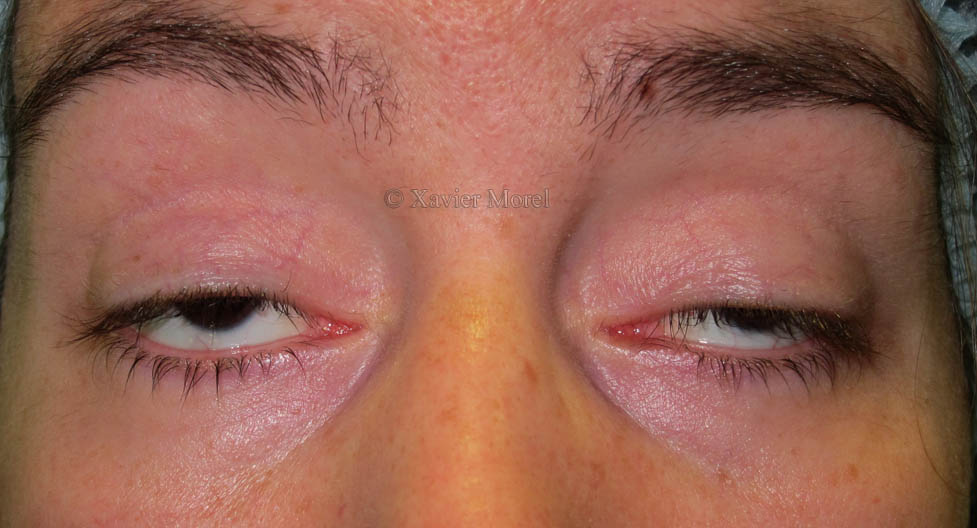 Ptosis sur myopathie oculo pharyngée
