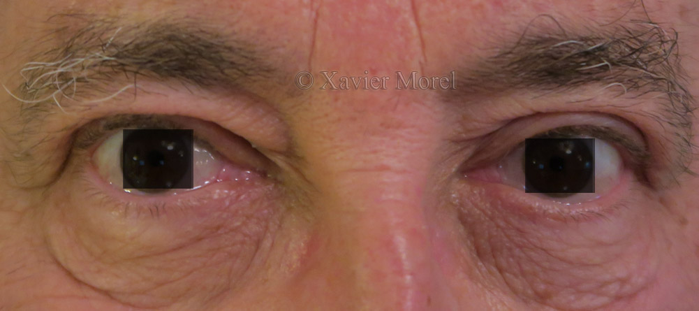 après chirurgie