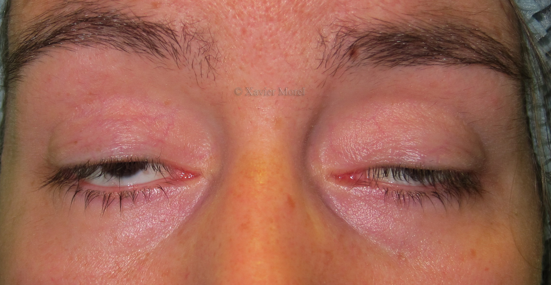 ptosis sur myopathie mitochondriale, avant chirurgie