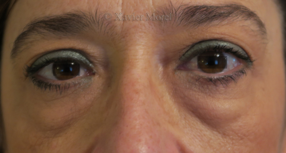 Pre opératoire blepharoplastie des 4 paupières