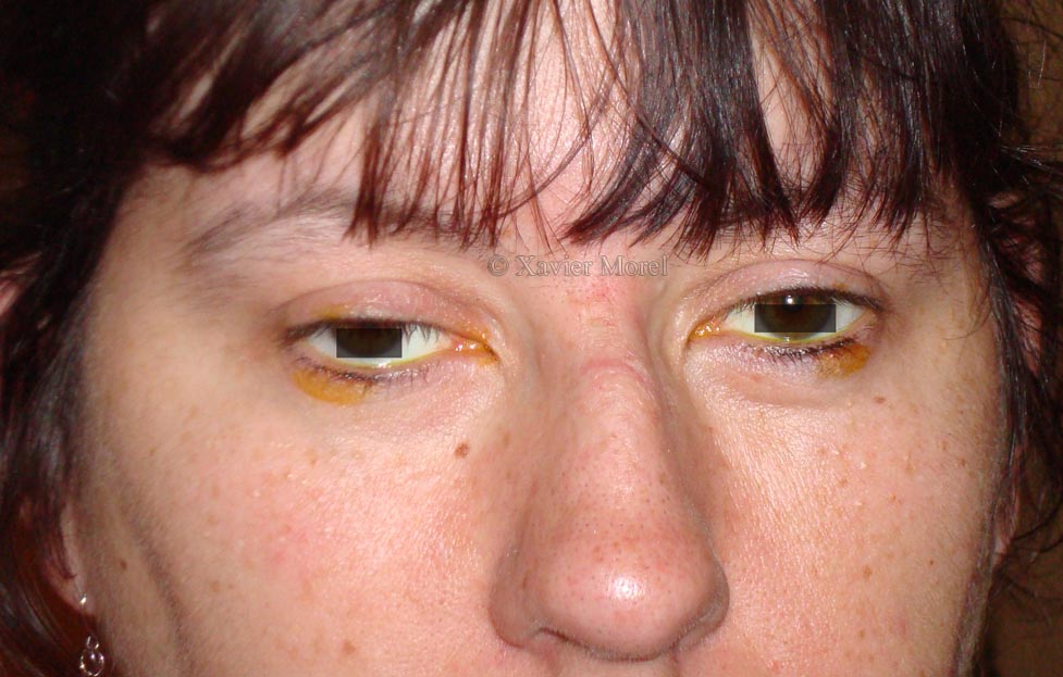 Ptosis myopathique sur maladie de Steinert