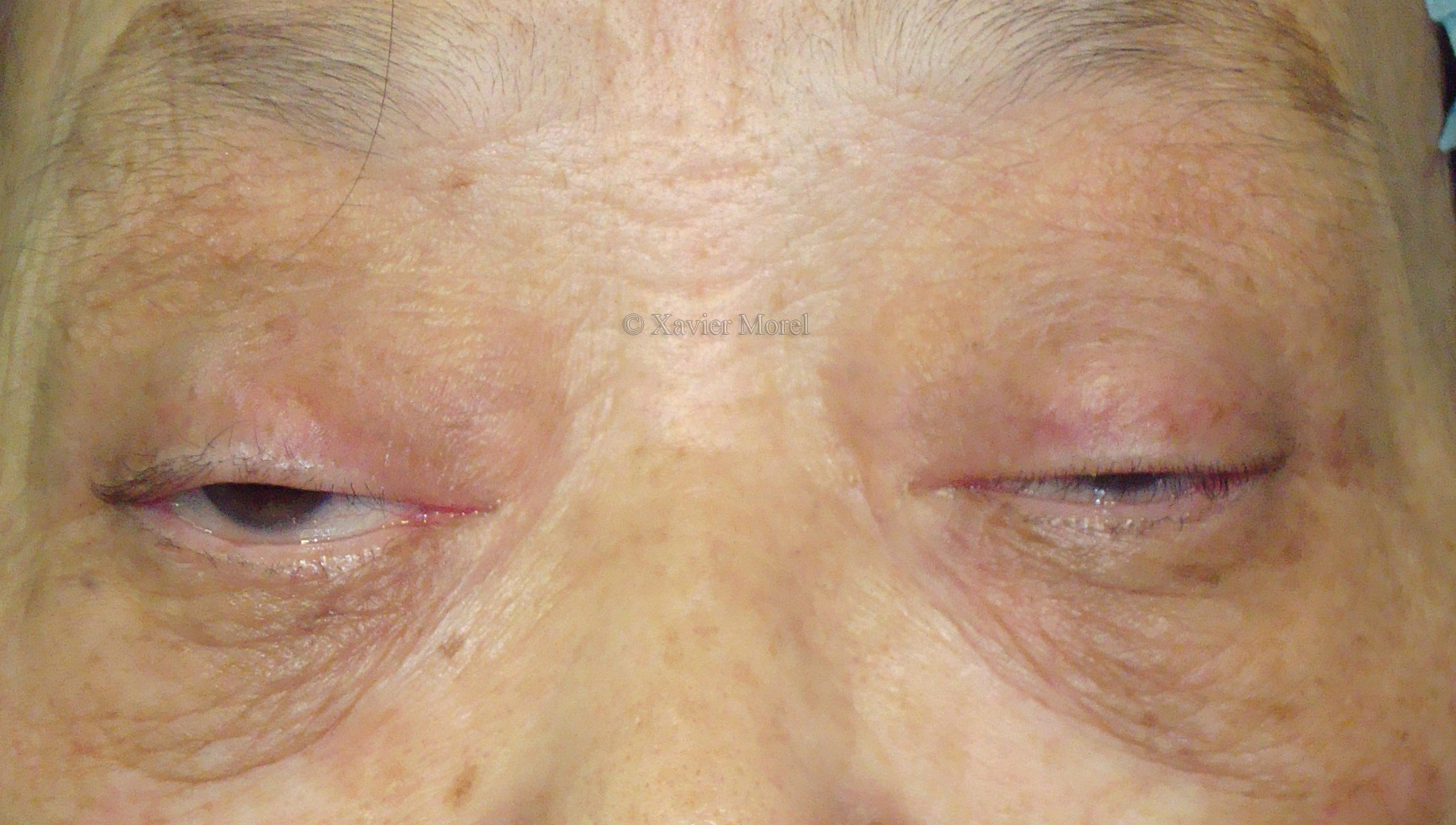 Ptosis myasthenique résistant au traitement médical