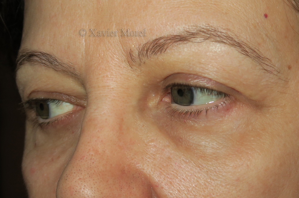 Post opératoire blepharoplastie 4 paupières