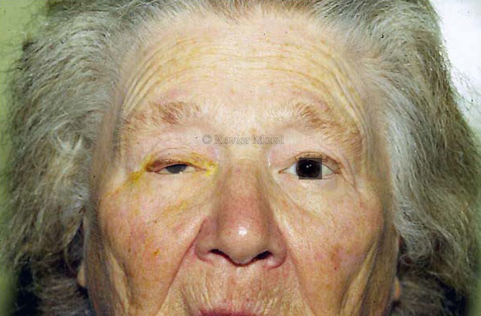 Ptosis de la personne âgée (ici  avec un entropion)