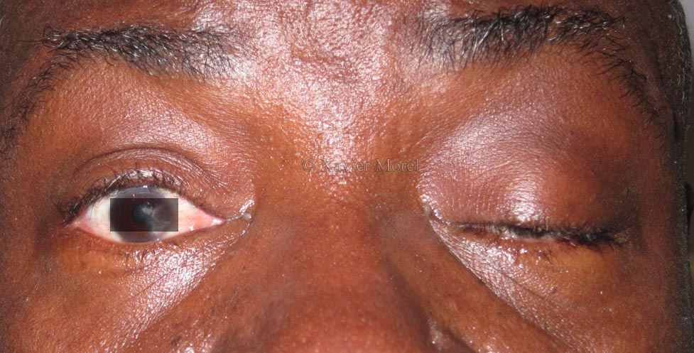 Ptosis après fracture du toit de l'orbite