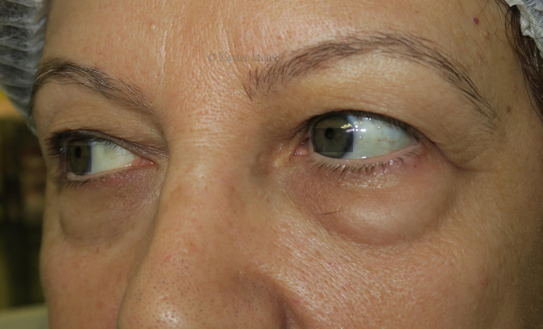Pre opératoire blepharoplastie 4  paupières