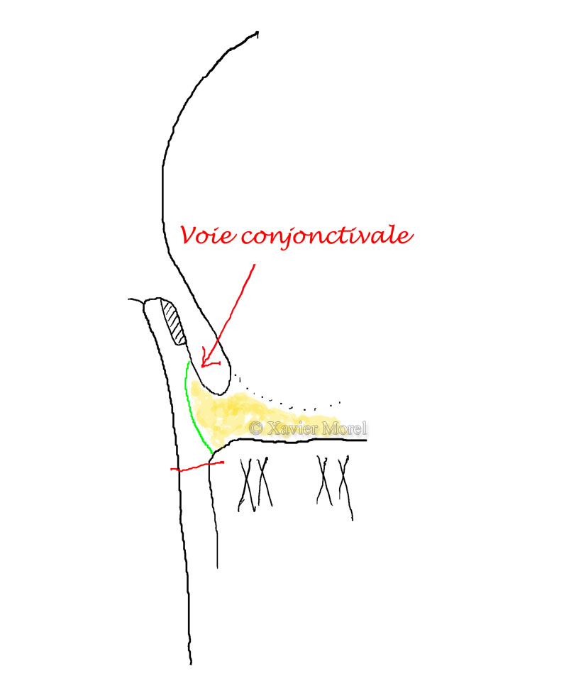 L'incision se fait par la face postérieure de la paupière