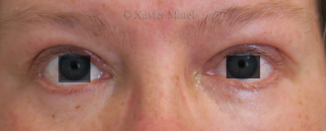 Après chirurgie