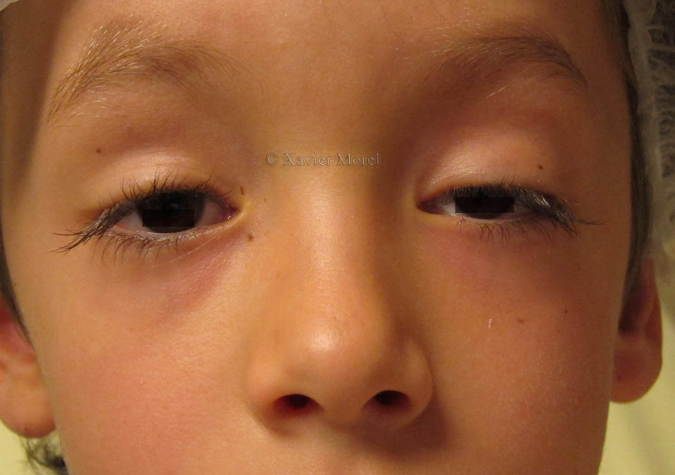 Ptosis congénital de l'enfant
