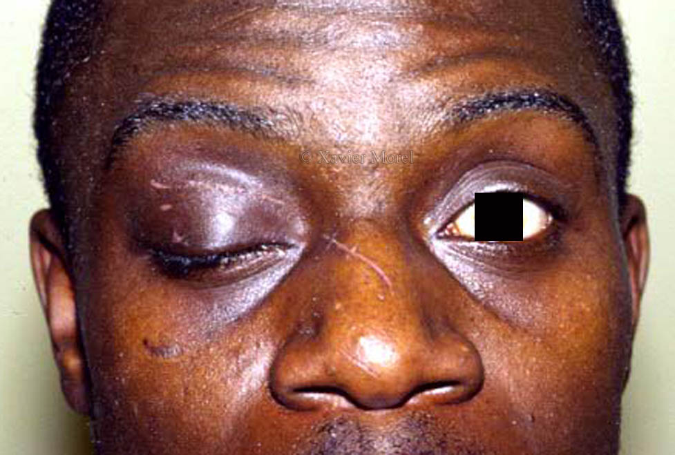 Ptosis après plaie palpébrale par couteau