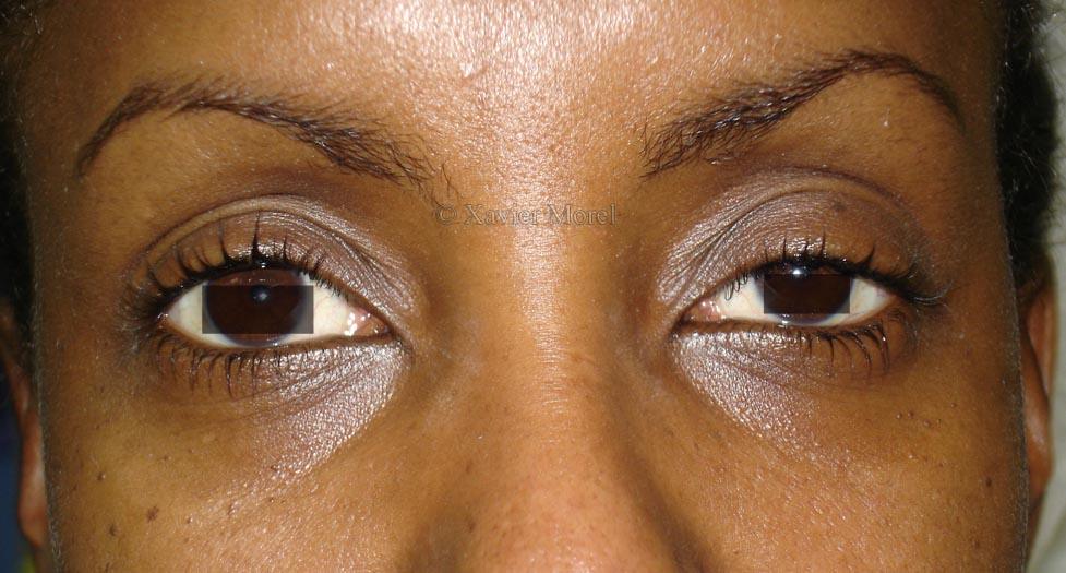 Ptosis congénital 