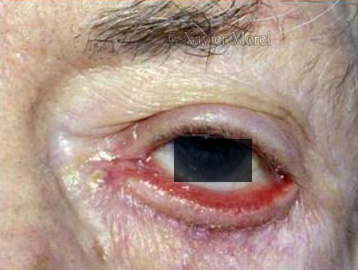 Ectropion involutif, présence de sécrétions