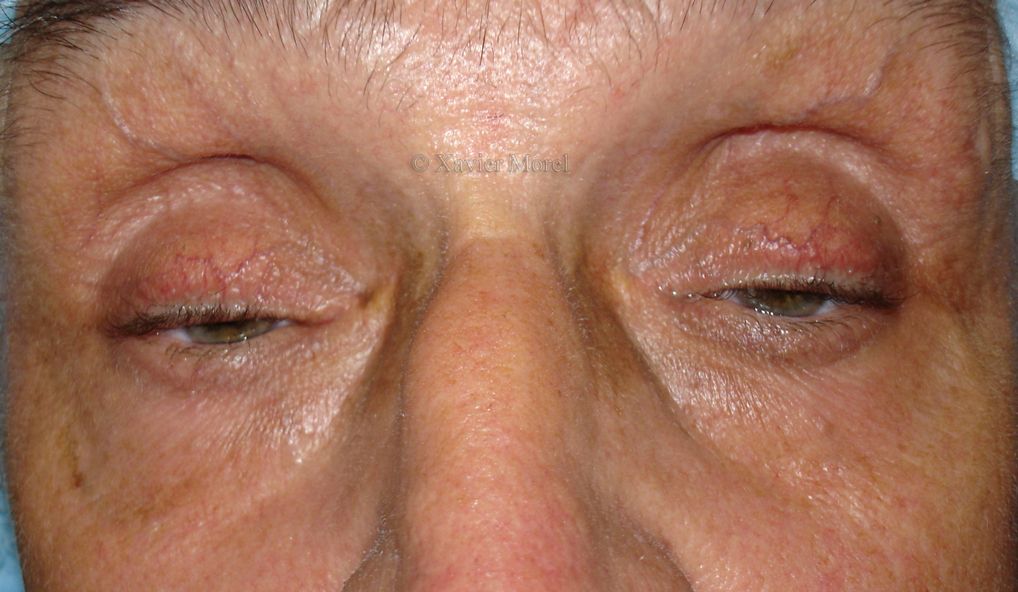 Avant la chirurgie (ptosis myopathique)