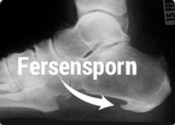 Fersensporn