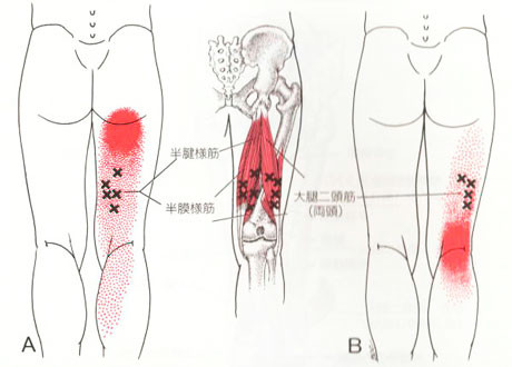膝裏のトリガーポイント