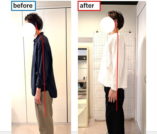 ストレートネックに頭痛が改善の写真