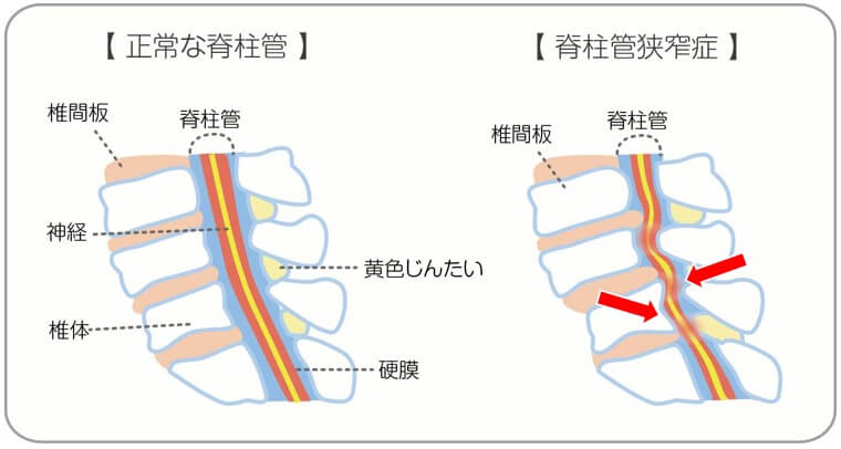 脊柱管狭窄症について詳しく書かれた図