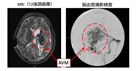 脳動静脈奇形 Cerebral arteriovenous malformation（AVM 