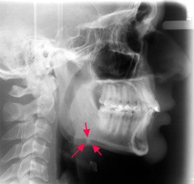 glándula submaxilar