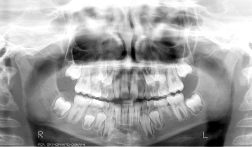 agenesia de piezas dentarias agenesia de piezas dentarias