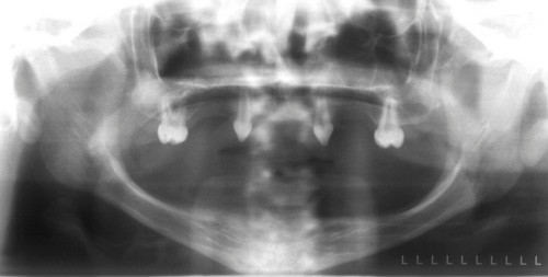 displasia ectodérmica uñas