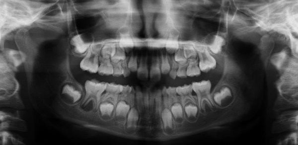 quiste mandibular bucal infectado