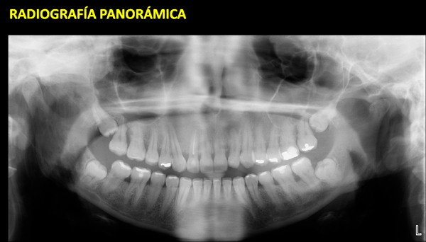 displasia fibrosa maxilar