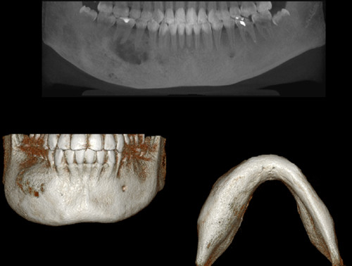 displasia fibrosa maxilar